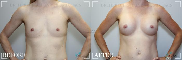 Before & After Breast Augmentation Case 259 Front View in St. Louis, MO