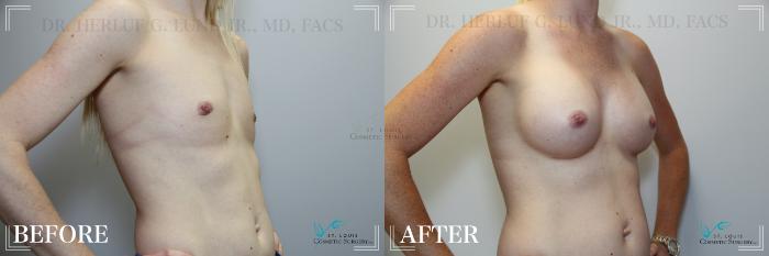 Before & After Breast Augmentation Case 259 Right Oblique View in St. Louis, MO