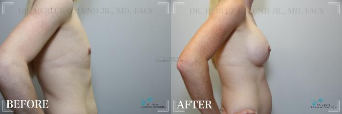 Before & After Breast Augmentation Case 259 Right Side View in St. Louis, MO