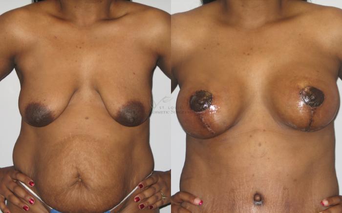 Before & After Breast Augmentation Case 26 View #1 View in St. Louis, MO
