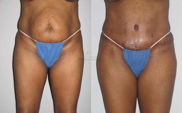 Before & After Breast Augmentation Case 26 View #3 View in St. Louis, MO