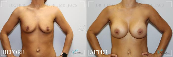 Before & After Breast Augmentation Case 260 Front View in St. Louis, MO