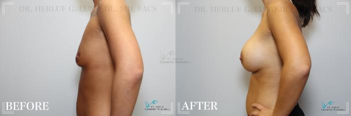 Before & After Breast Augmentation Case 260 Left Side View in St. Louis, MO