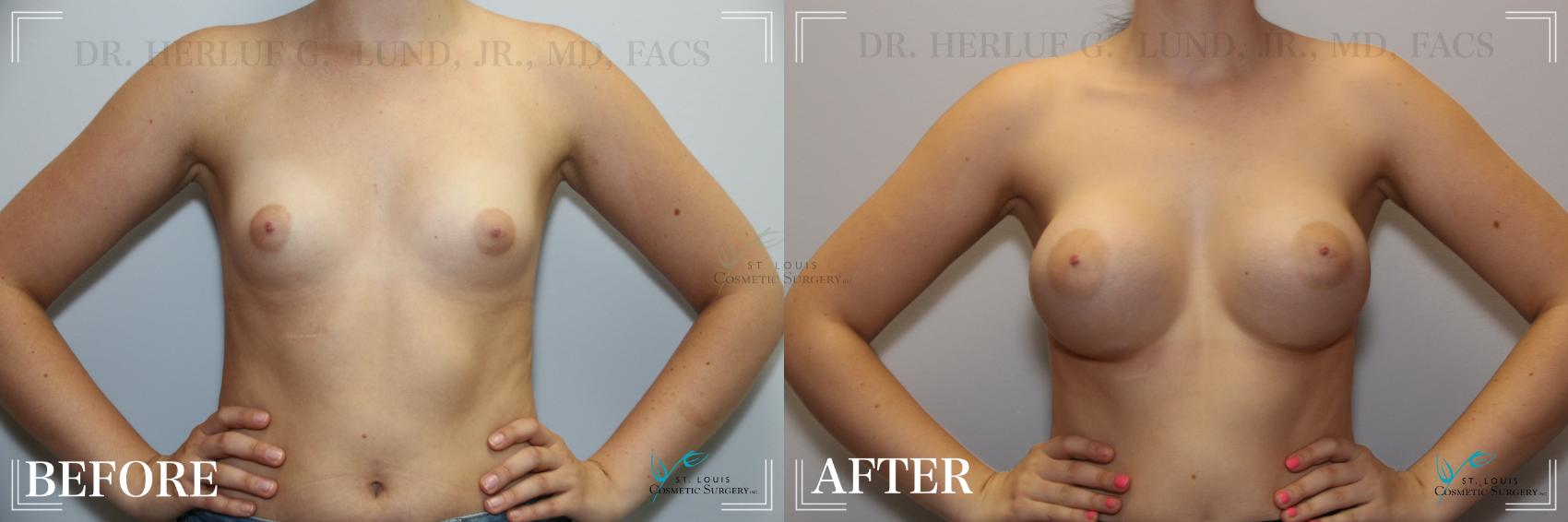 Before & After Breast Augmentation Case 261 Front View in St. Louis, MO