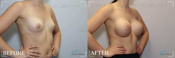 Before & After Breast Augmentation Case 261 Right Oblique View in St. Louis, MO