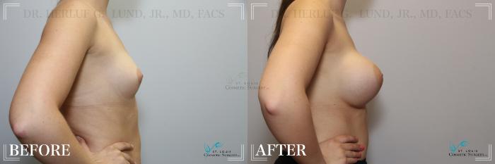Before & After Breast Augmentation Case 261 Right Side View in St. Louis, MO
