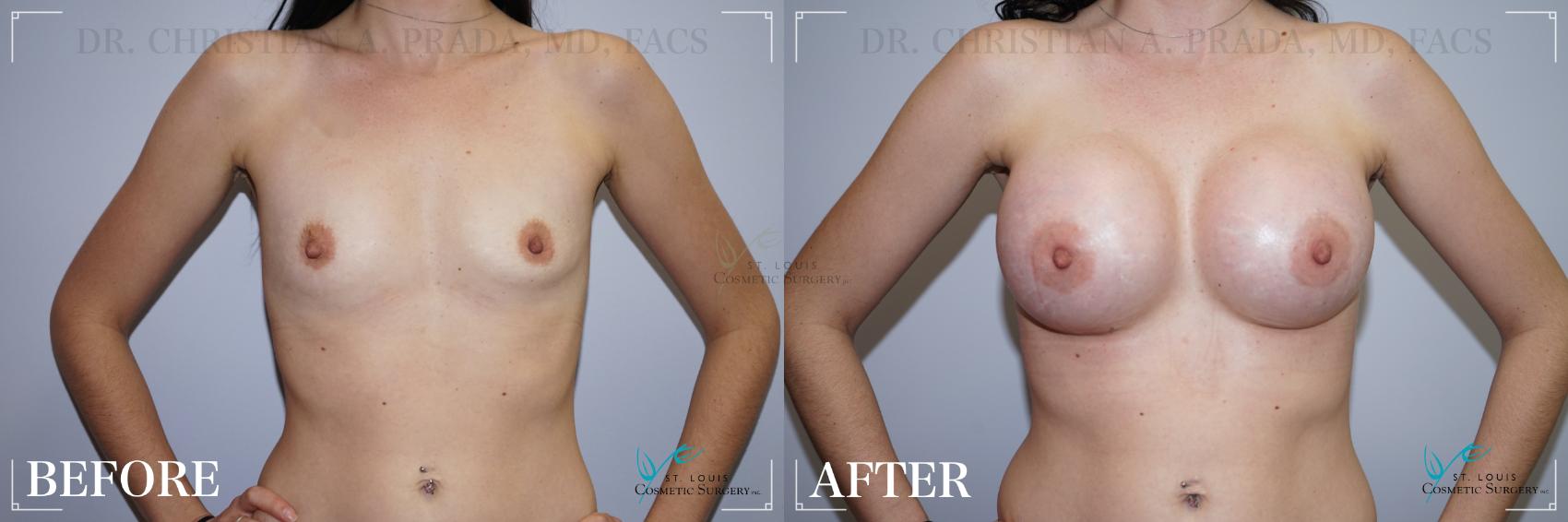 Before & After Breast Augmentation Case 267 Front View in St. Louis, MO
