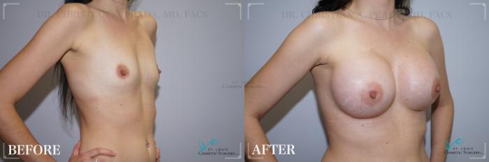 Before & After Breast Augmentation Case 267 Right Oblique View in St. Louis, MO