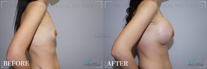 Before & After Breast Augmentation Case 267 Right Side View in St. Louis, MO