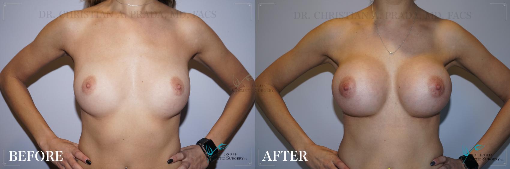 Before & After Breast Augmentation Case 268 Front View in St. Louis, MO