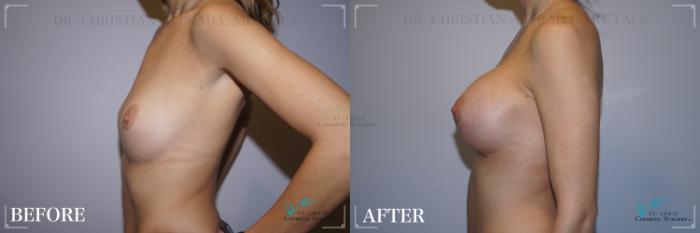 Before & After Breast Augmentation Case 268 Left Side View in St. Louis, MO