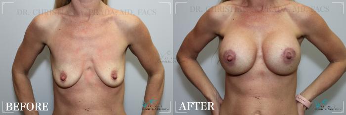 Before & After Breast Augmentation Case 269 Front View in St. Louis, MO