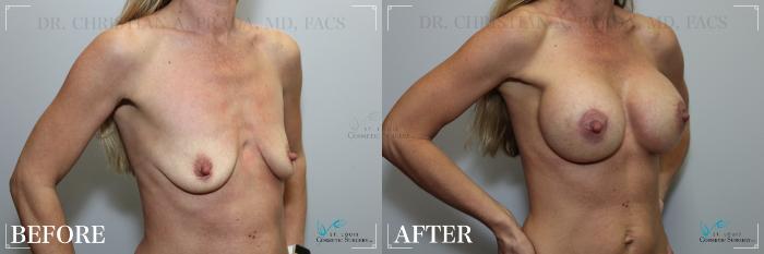 Before & After Breast Augmentation Case 269 Right Oblique View in St. Louis, MO