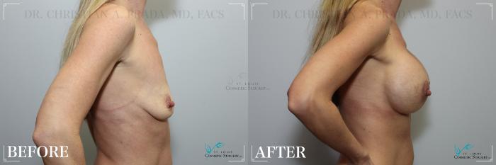 Before & After Breast Augmentation Case 269 Right Side View in St. Louis, MO