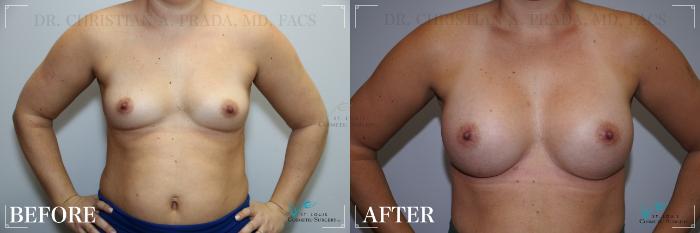 Before & After Breast Augmentation Case 270 Front View in St. Louis, MO