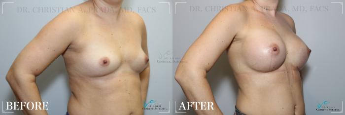 Before & After Breast Augmentation Case 270 Right Oblique View in St. Louis, MO