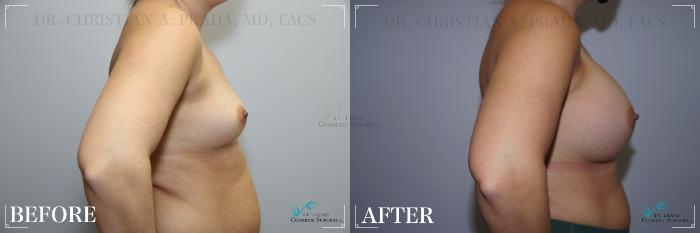 Before & After Breast Augmentation Case 270 Right Side View in St. Louis, MO