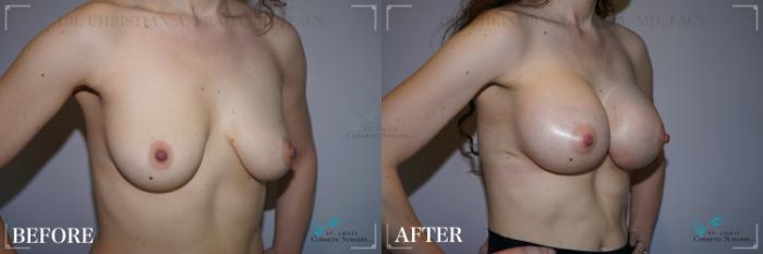 Before & After Breast Augmentation Case 273 Right Oblique View in St. Louis, MO