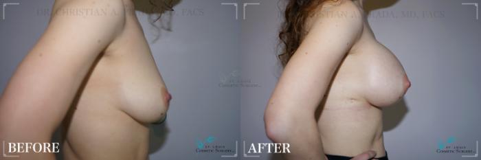 Before & After Breast Augmentation Case 273 Right Side View in St. Louis, MO