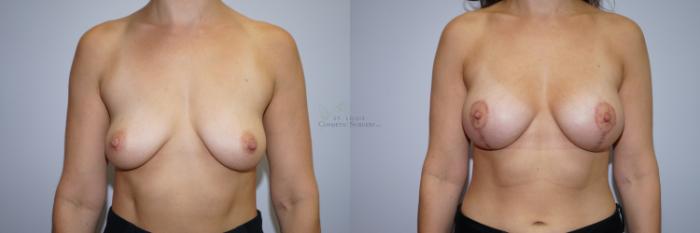 Before & After Breast Augmentation Case 285 Front View in St. Louis, MO