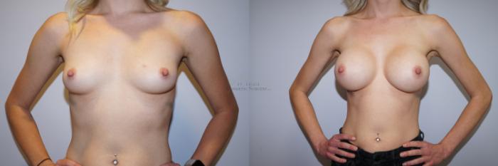 Before & After Breast Augmentation Case 286 Front View in St. Louis, MO