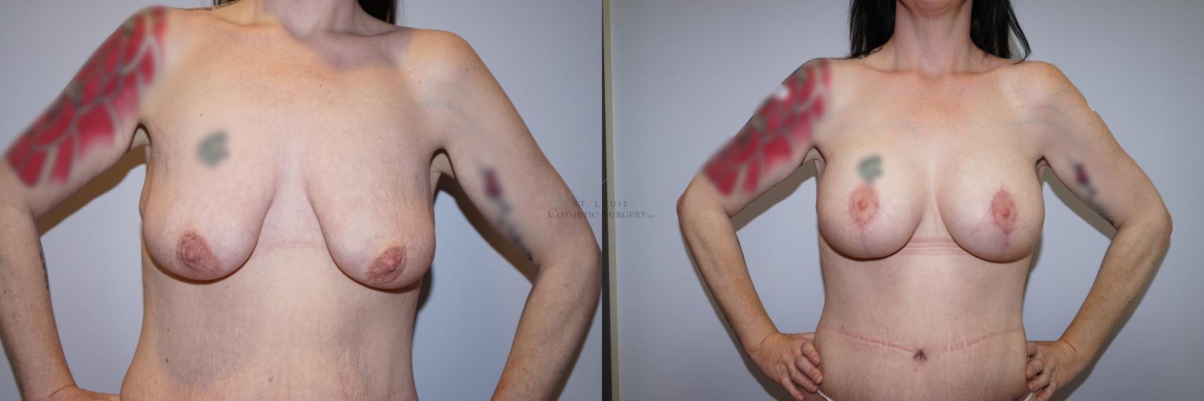 Before & After Breast Lift Case 288 Front View in St. Louis, MO