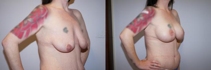 Before & After Breast Augmentation Case 288 Left Oblique View in St. Louis, MO