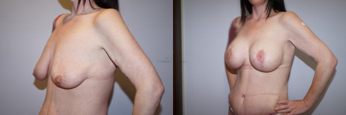 Before & After Breast Lift Case 288 Right Oblique View in St. Louis, MO