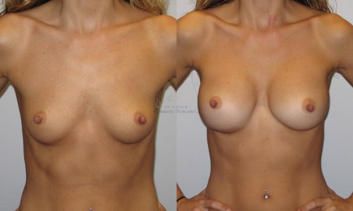 Before & After Breast Augmentation Case 29 View #1 View in St. Louis, MO