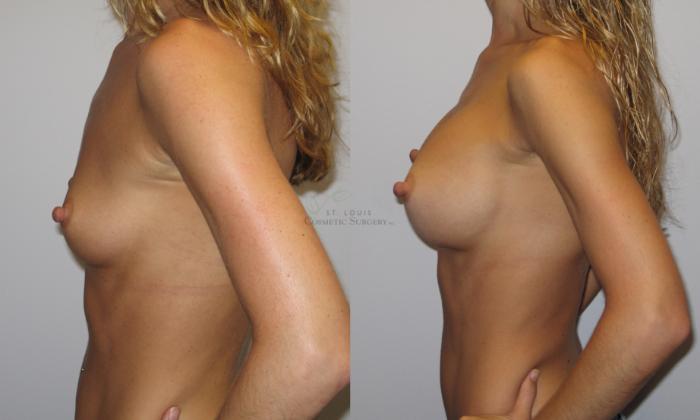 Before & After Breast Augmentation Case 29 View #2 View in St. Louis, MO