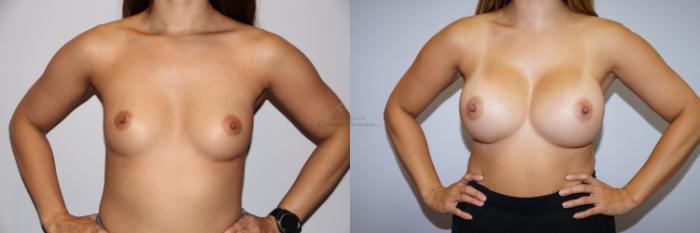 Before & After Breast Augmentation Case 293 Front View in St. Louis, MO