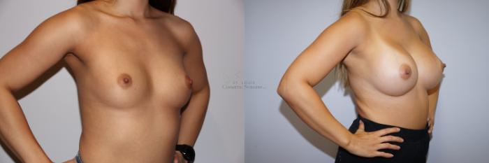 Before & After Breast Augmentation Case 293 Left Oblique View in St. Louis, MO