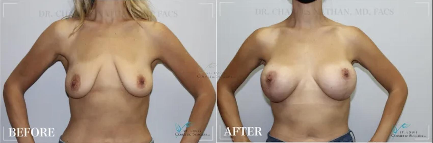 Before & After Breast Augmentation Case 305 View #1 View in St. Louis, MO