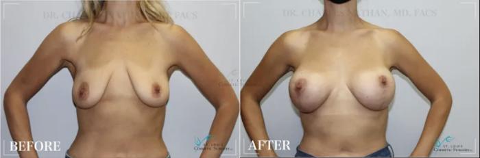 Before & After Breast Augmentation Case 305 View #1 View in St. Louis, MO