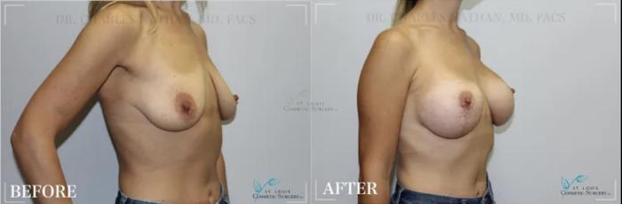 Before & After Breast Augmentation Case 305 View #2 View in St. Louis, MO