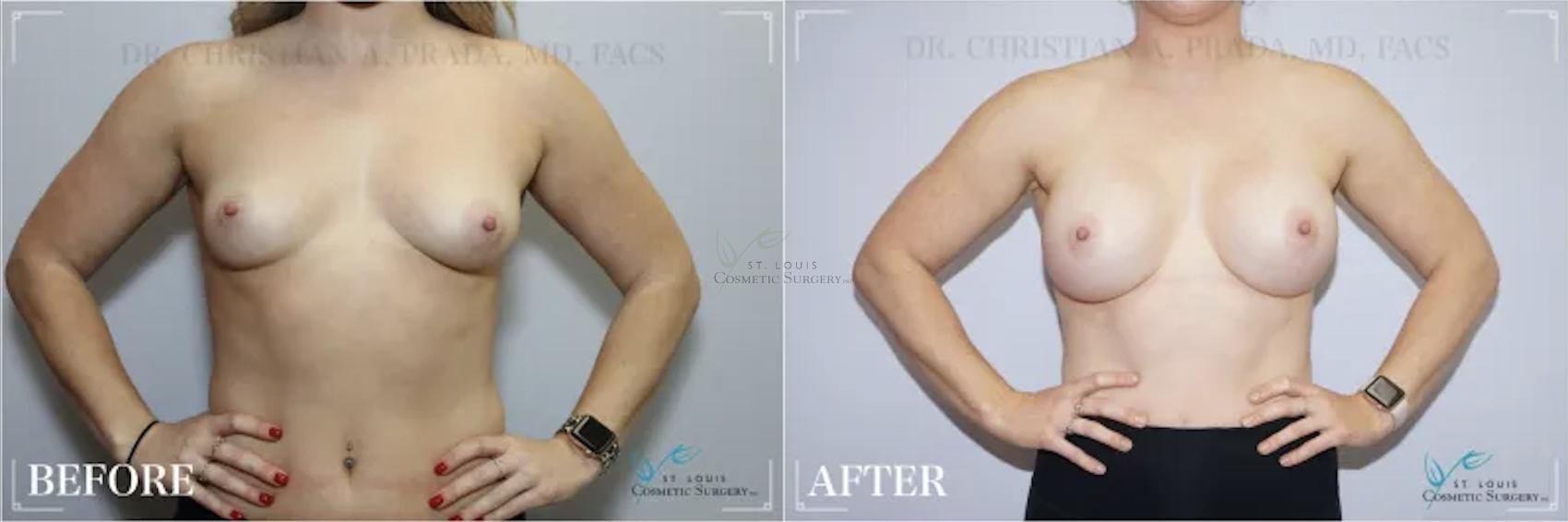 Before & After Breast Augmentation Case 309 View #1 View in St. Louis, MO