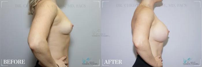 Before & After Breast Augmentation Case 309 View #2 View in St. Louis, MO