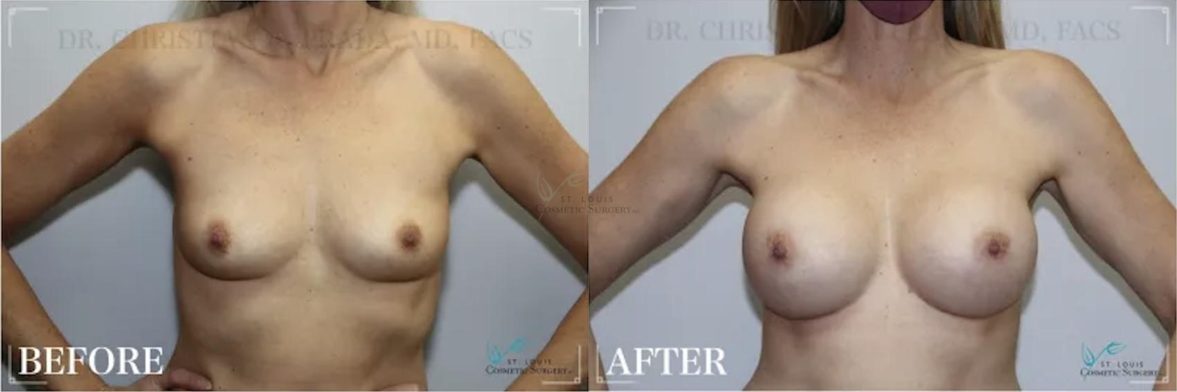 Before & After Breast Augmentation Case 310 View #1 View in St. Louis, MO