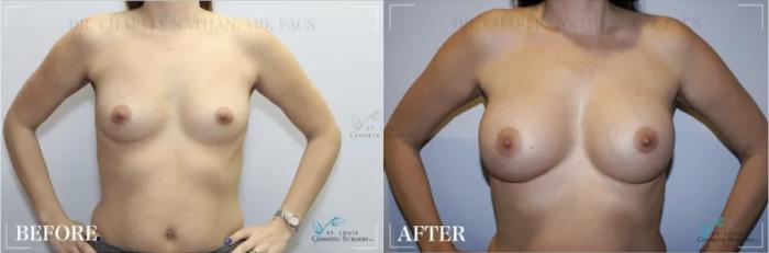 Before & After Breast Augmentation Case 311 View #1 View in St. Louis, MO