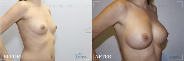 Before & After Breast Augmentation Case 311 View #2 View in St. Louis, MO