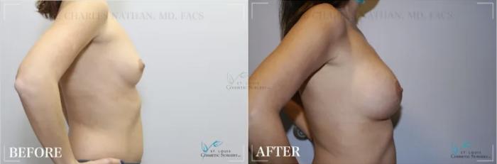 Before & After Breast Augmentation Case 311 View #3 View in St. Louis, MO