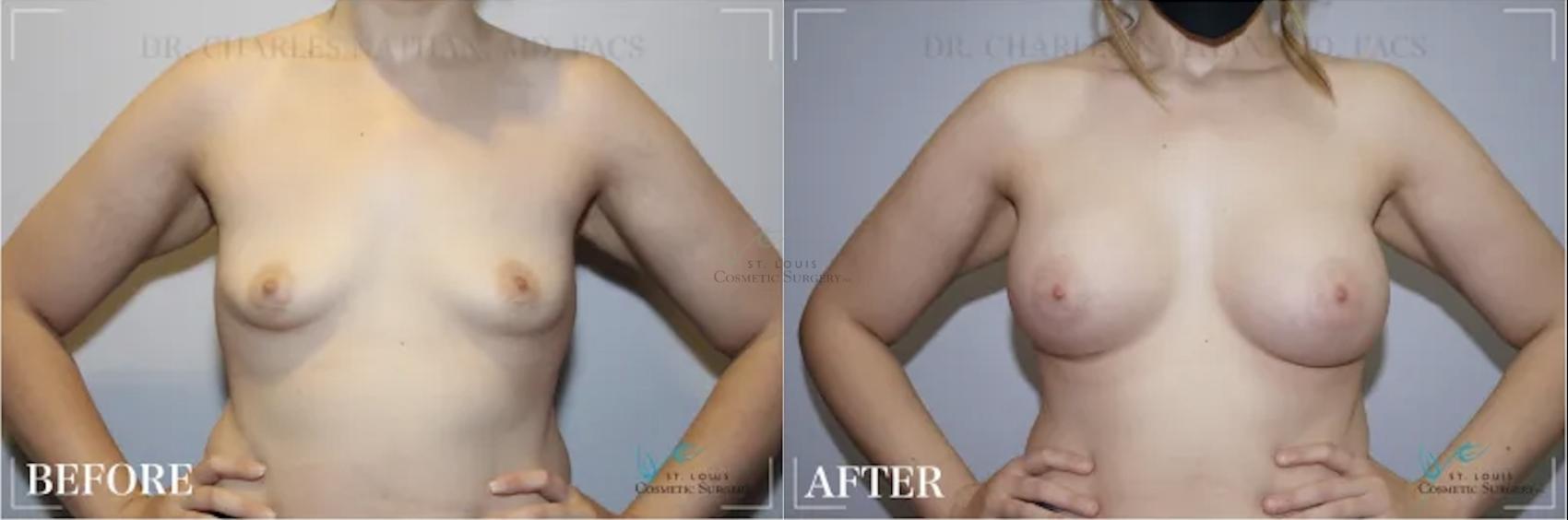 Before & After Breast Augmentation Case 312 View #1 View in St. Louis, MO
