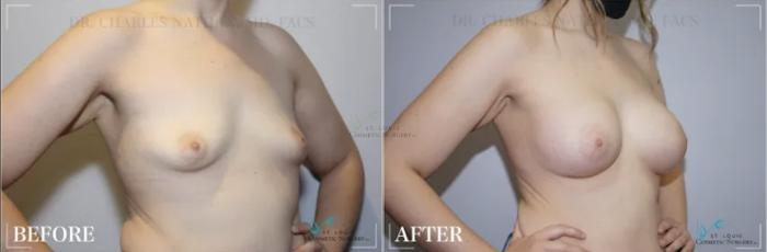 Before & After Breast Augmentation Case 312 View #2 View in St. Louis, MO