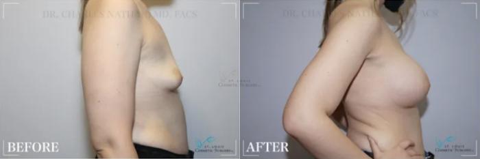 Before & After Breast Augmentation Case 312 View #3 View in St. Louis, MO