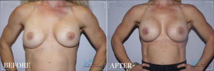 Before & After Breast Augmentation Case 317 View #1 View in St. Louis, MO