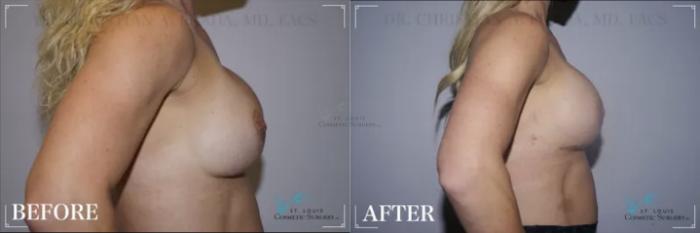 Before & After Breast Augmentation Case 317 View #2 View in St. Louis, MO