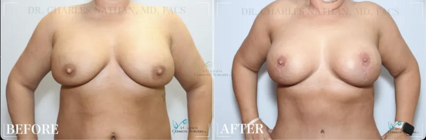 Before & After Breast Augmentation Case 318 View #1 View in St. Louis, MO