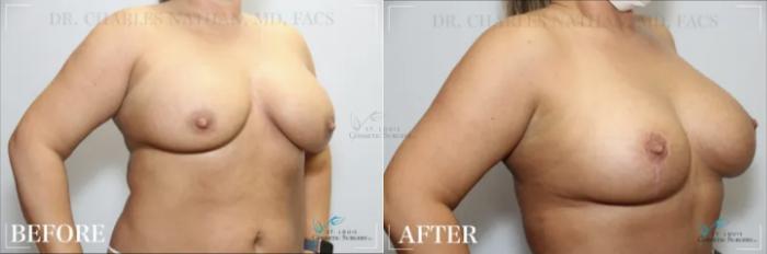 Before & After Breast Augmentation Case 318 View #2 View in St. Louis, MO