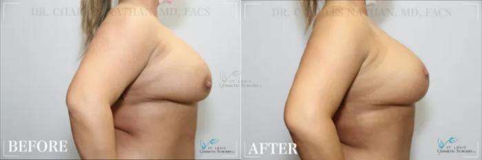 Before & After Breast Augmentation Case 318 View #3 View in St. Louis, MO