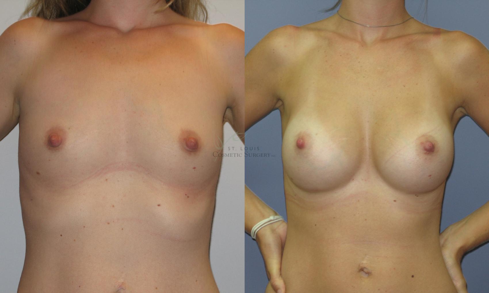 Before & After Breast Augmentation Case 32 View #1 View in St. Louis, MO